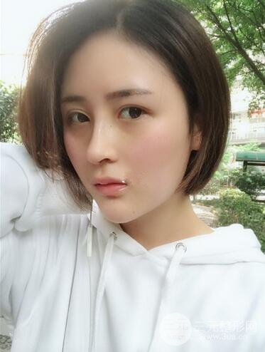 上海李鴻君隆鼻果圖片恢復(fù)日記分享