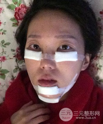 深圳內(nèi)切去眼袋+硅膠墊下巴真實案例恢復(fù)果圖