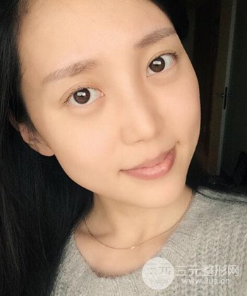 深圳內(nèi)切去眼袋+硅膠墊下巴真實案例恢復(fù)果圖