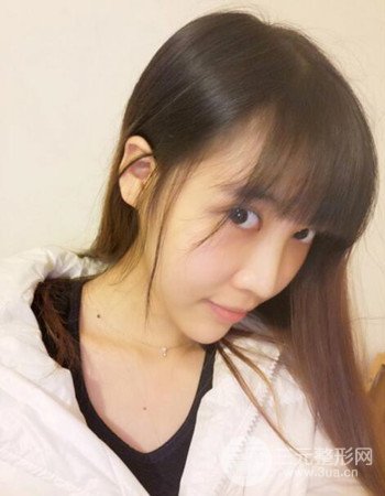 北京吸脂瘦臉真人案例恢復(fù)過程分享，巴掌小臉不是夢