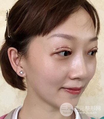 北京雙眼皮失敗修復(fù)手術(shù)日記分享，附上前后對(duì)比照片