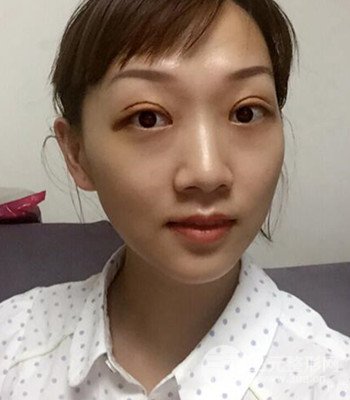 北京雙眼皮失敗修復(fù)手術(shù)日記分享，附上前后對(duì)比照片