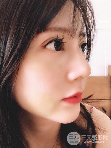 夏正義做鼻子怎么樣？隆鼻案例日記記錄