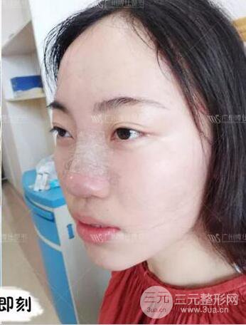 廣州博仕隆鼻失敗修復(fù)案例，前后恢復(fù)過(guò)程分享~