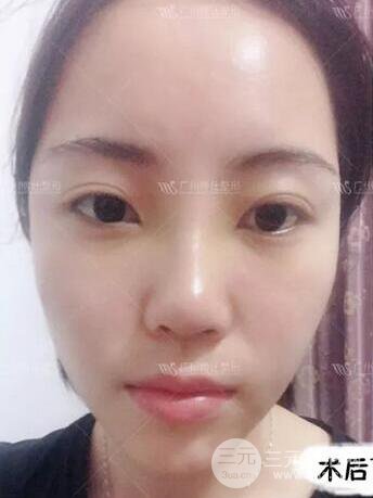廣州博仕隆鼻失敗修復(fù)案例，前后恢復(fù)過(guò)程分享~