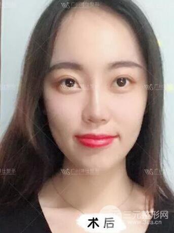 廣州博仕隆鼻失敗修復(fù)案例，前后恢復(fù)過(guò)程分享~