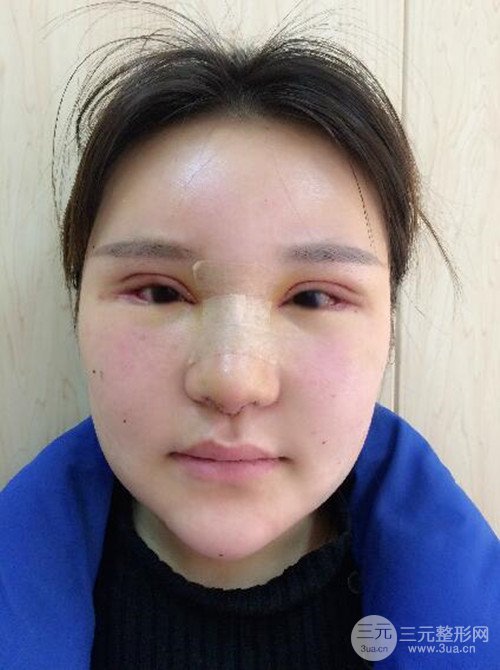 上海麗質(zhì)呂成醫(yī)生做的吸脂瘦臉日記，前后恢復(fù)圖分享