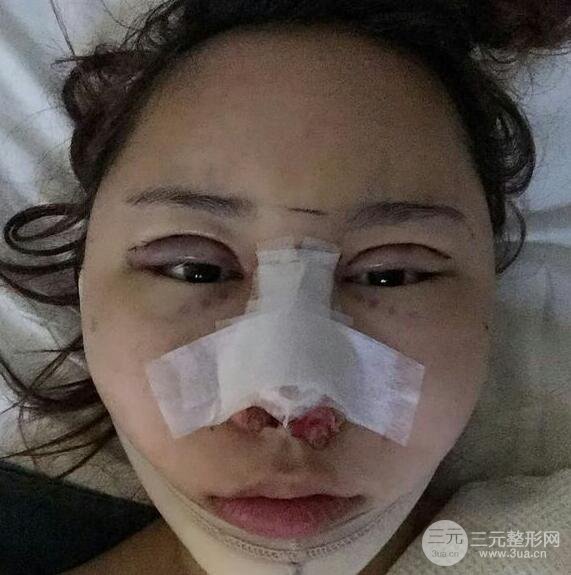 青島伊美爾國賓切開雙眼皮+隆鼻整形+硅膠墊下巴案例分享，附上前后對(duì)比照片