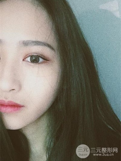 廣州曙光劉杰偉醫(yī)生切開雙眼皮案例，前后對比圖分享