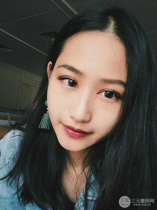 廣州曙光劉杰偉醫(yī)生切開雙眼皮案例，前后對比圖分享