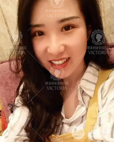 南京維多利亞切開雙眼皮+開眼角案例分享，附上前后對比圖