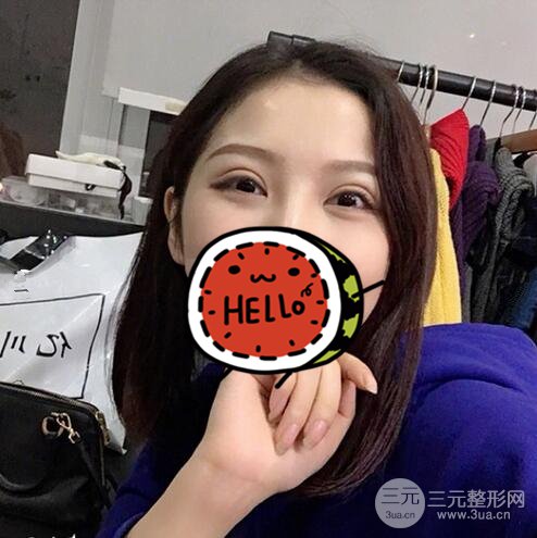 北京京民郭建玲割的雙眼皮案例術(shù)后一年果