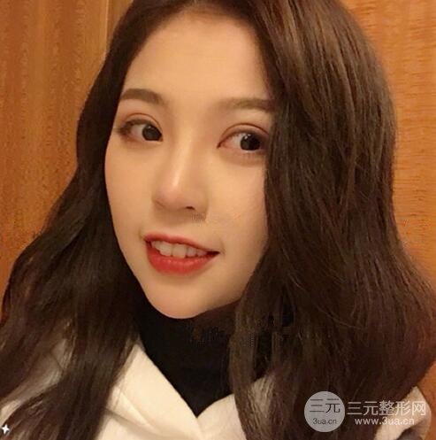 北京京民郭建玲割的雙眼皮案例術(shù)后一年果