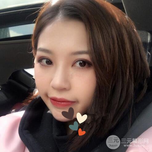 北京京民郭建玲割的雙眼皮案例術(shù)后一年果