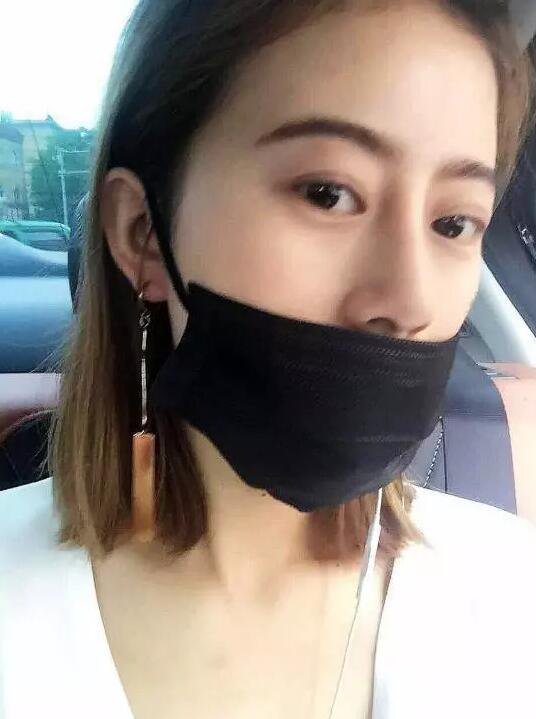 成都心悅?cè)菽咴浦炯袤w隆鼻前后恢復(fù)過程分享