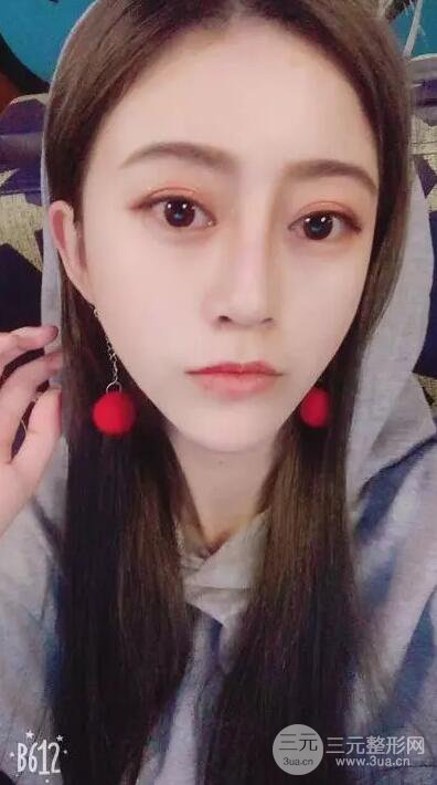 成都心悅?cè)菽咴浦炯袤w隆鼻前后恢復(fù)過程分享