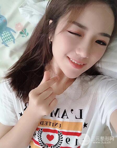 廣州海峽軍隆鼻失敗修復案例術(shù)后記錄