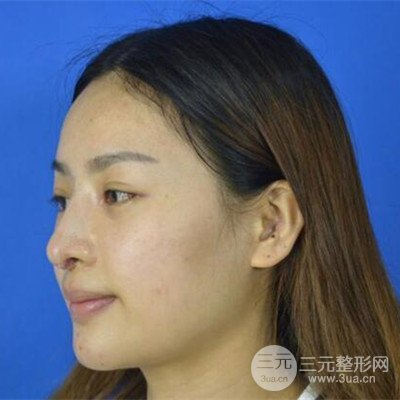 廣州藝美李闖醫(yī)生隆鼻整形恢復記錄分享~