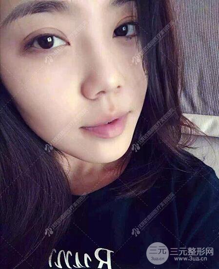 沈陽百嘉麗侯亞杰光纖溶脂瘦臉恢復(fù)日記