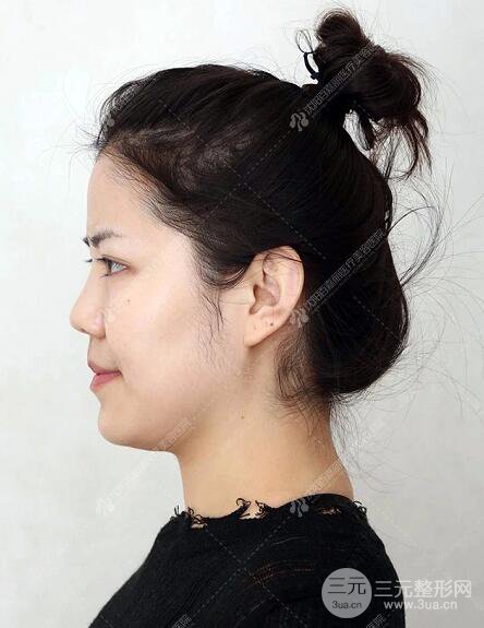 沈陽百嘉麗侯亞杰光纖溶脂瘦臉恢復(fù)日記