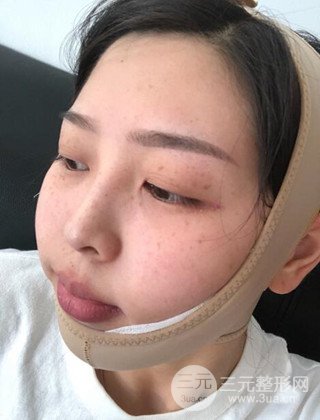 面部吸脂瘦臉手術(shù)日記分享，瘦臉果驚人