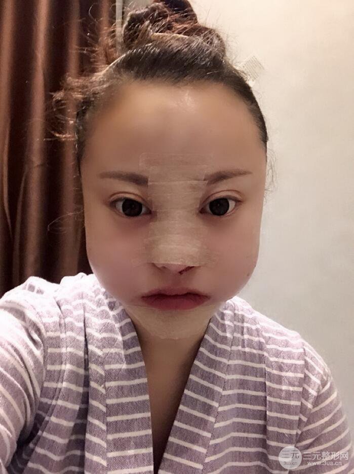 太原麗都面部吸脂+假體隆鼻案例分享，精致面部小V臉了解一下~