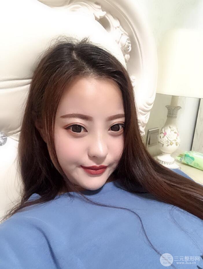 太原麗都面部吸脂+假體隆鼻案例分享，精致面部小V臉了解一下~