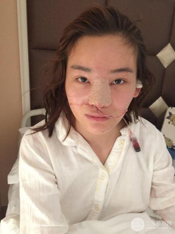 南京華美曹海峰隆鼻整形日記恢復(fù)圖片分享~