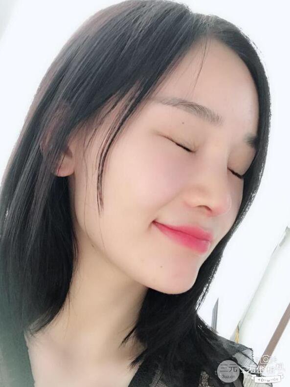 南京華美曹海峰隆鼻整形日記恢復(fù)圖片分享~