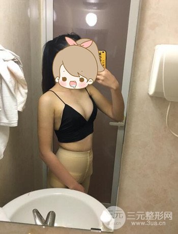 北京自體脂肪隆胸手術(shù)日記分享，豐胸術(shù)后恢復(fù)果圖