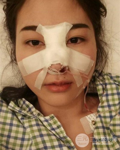 膨體隆鼻案例分享，四川華人醫(yī)療游曉波醫(yī)生做的!