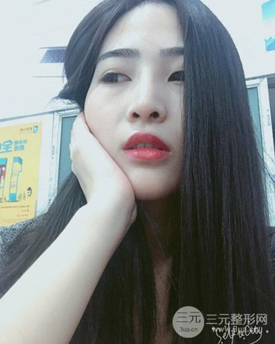 膨體隆鼻案例分享，四川華人醫(yī)療游曉波醫(yī)生做的!