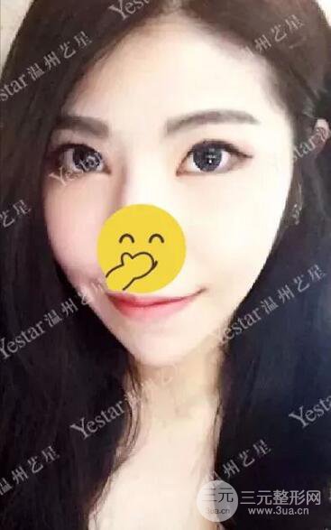 溫州藝星打B****案例術后恢復日記