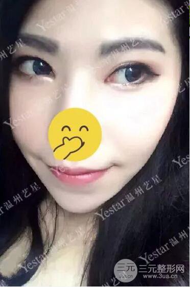 溫州藝星打B****案例術后恢復日記