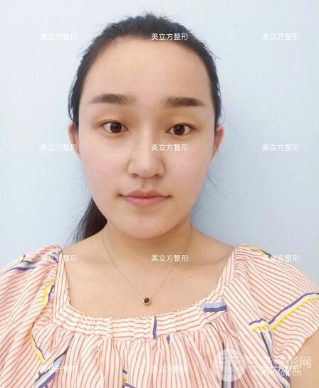 西安美立方李蓉華割雙眼皮案例術(shù)后恢復日記