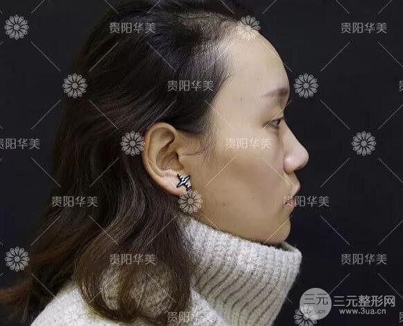 貴陽華美整形田永華雙眼皮+隆鼻+脂肪填充術(shù)后恢復(fù)日記