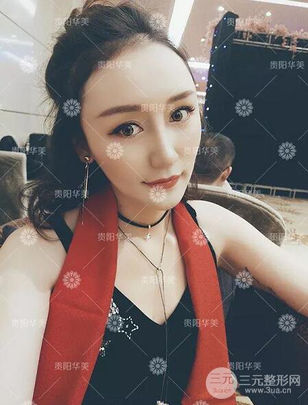 貴陽華美整形田永華雙眼皮+隆鼻+脂肪填充術(shù)后恢復(fù)日記