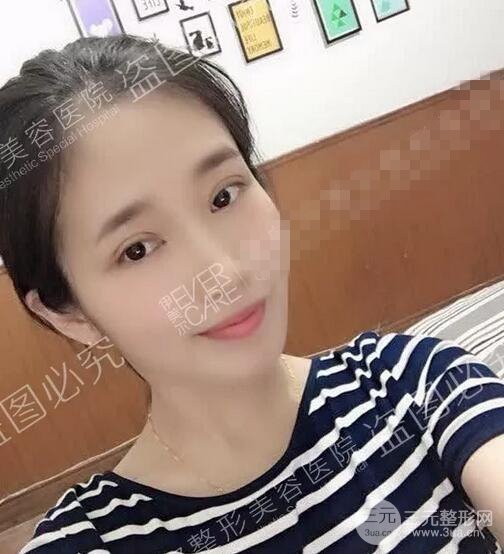 伊美爾秦宏偉雙眼皮案例術(shù)后15天果圖展示