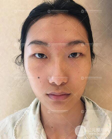 煤炭總醫(yī)院雙眼皮整形案例術(shù)后恢復(fù)一個月果