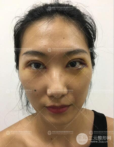 煤炭總醫(yī)院雙眼皮整形案例術(shù)后恢復(fù)一個月果