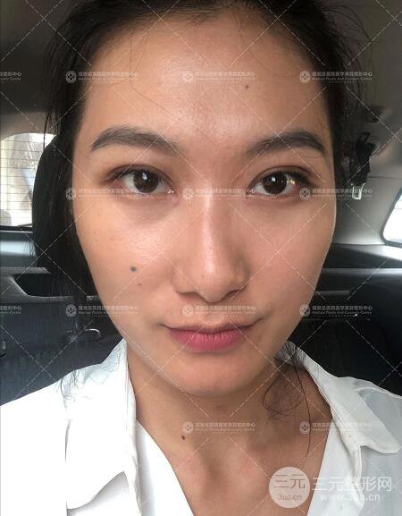 煤炭總醫(yī)院雙眼皮整形案例術(shù)后恢復(fù)一個月果