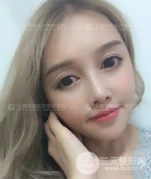 隆鼻失敗修復(fù)+詳細(xì)部自體脂肪填充案例分享，上海華美做的!
