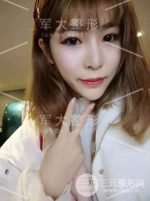 四川軍大自體脂肪面部填充案例分享