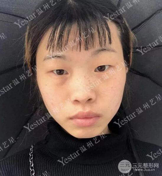 溫州藝星雙眼皮+隆鼻+自體脂肪填充案例果圖片