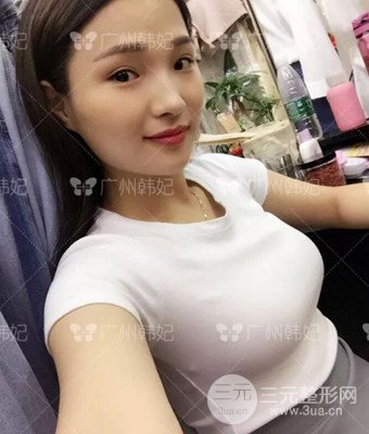 廣州韓妃劉志剛自體脂肪豐胸案例前后對(duì)比圖分享~