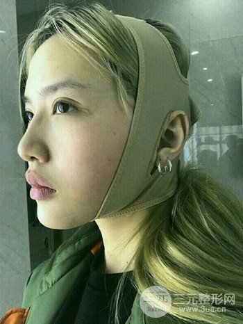 大圓臉做了面部吸脂瘦臉果很棒，立現(xiàn)漂亮鵝蛋臉