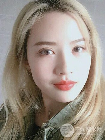 大圓臉做了面部吸脂瘦臉果很棒，立現(xiàn)漂亮鵝蛋臉