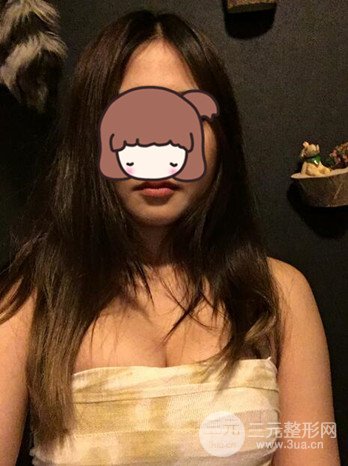 職業(yè)模特做了假體隆胸手術(shù)分享手術(shù)恢復照片