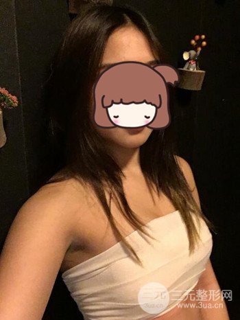 職業(yè)模特做了假體隆胸手術(shù)分享手術(shù)恢復照片