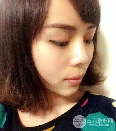 北京伊美爾徐軍假體隆鼻前后對(duì)比照片心情日記